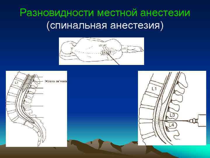 Разновидности местной анестезии (спинальная анестезия) 