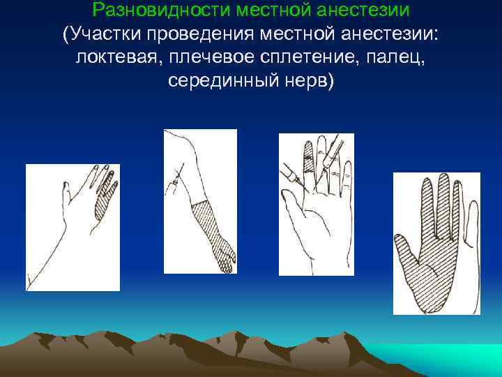 Разновидности местной анестезии (Участки проведения местной анестезии: локтевая, плечевое сплетение, палец, серединный нерв) 