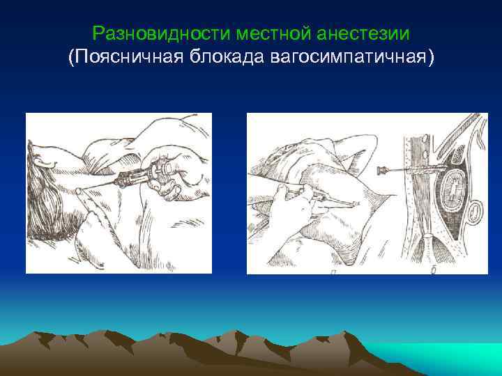 Разновидности местной анестезии (Поясничная блокада вагосимпатичная) 