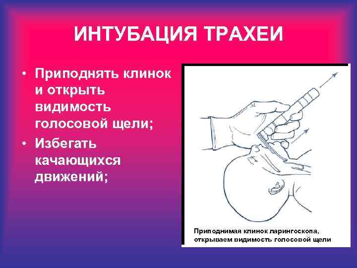 ИНТУБАЦИЯ ТРАХЕИ • Приподнять клинок и открыть видимость голосовой щели; • Избегать качающихся движений;