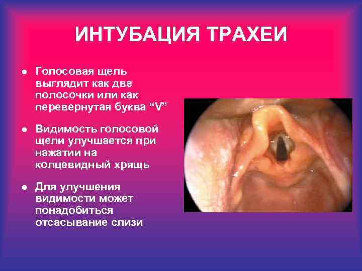 ИНТУБАЦИЯ ТРАХЕИ l Голосовая щель выглядит как две полосочки или как перевернутая буква “V”