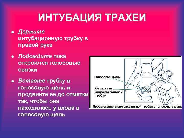ИНТУБАЦИЯ ТРАХЕИ l Держите интубационную трубку в правой руке l Подождите пока откроются голосовые