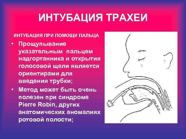 ИНТУБАЦИЯ ТРАХЕИ ИНТУБАЦИЯ ПРИ ПОМОЩИ ПАЛЬЦА • Прощупывание указательным пальцем надгортанника и открытия голосовой