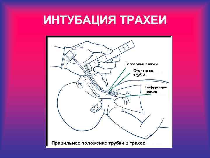 ИНТУБАЦИЯ ТРАХЕИ Голосовые связки Отметка на трубке Бифуркация трахеи Правильное положение трубки в трахее
