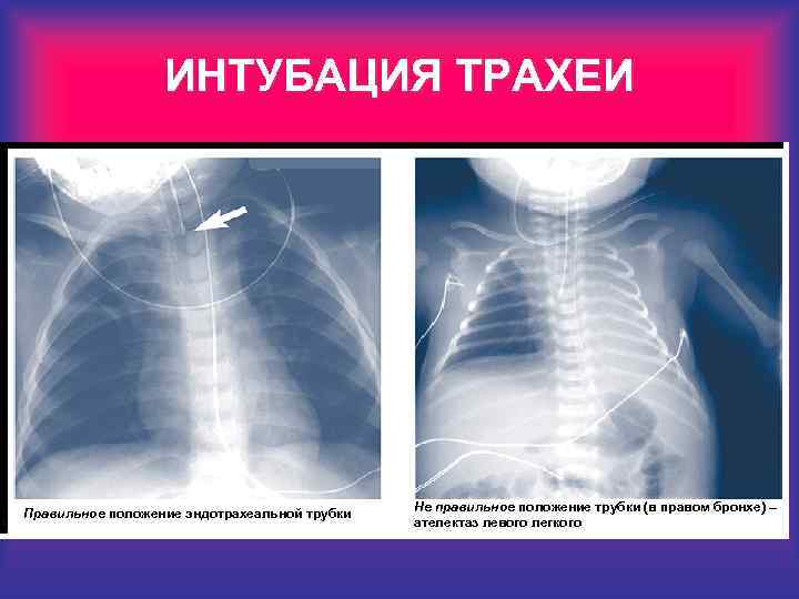 ИНТУБАЦИЯ ТРАХЕИ Правильное положение эндотрахеальной трубки Не правильное положение трубки (в правом бронхе) –