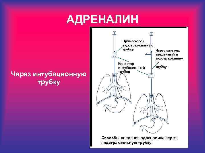 АДРЕНАЛИН Прямо через эндотрахеальную трубку Через катетер, введенный в эндотрахеальну ю Конектор трубку интубационной