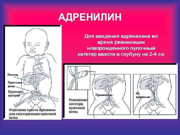 АДРЕНИЛИН Для введения адреналина во время реанимации новорожденного пупочный катетер ввести в глубуну на