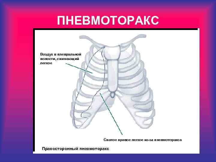 ПНЕВМОТОРАКС Воздух в плевральной полости, сжимающий легкое Сжатое правое легкое из-за пневмоторакса Правосторонный пневмоторакс