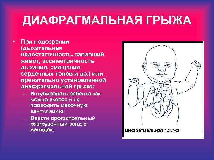 ДИАФРАГМАЛЬНАЯ ГРЫЖА • При подозрении (дыхательная недостаточность, запавший живот, ассиметричность дыхания, смещение сердечных тонов