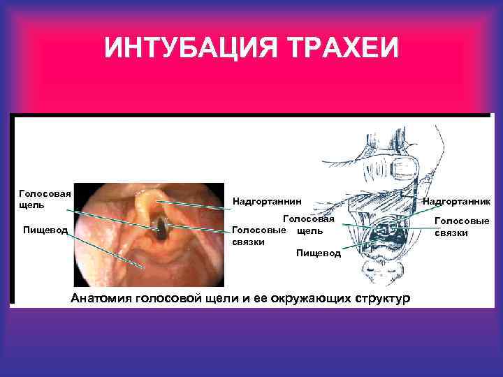 ИНТУБАЦИЯ ТРАХЕИ Голосовая щель Пищевод Надгортаннин Голосовая Голосовые щель связки Пищевод Анатомия голосовой щели