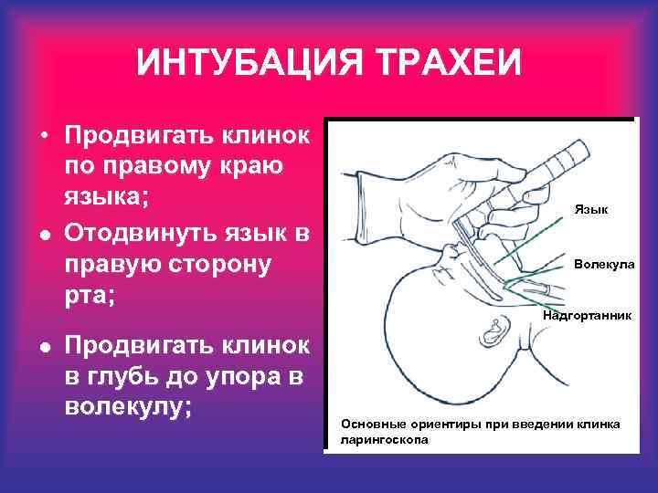 ИНТУБАЦИЯ ТРАХЕИ • Продвигать клинок по правому краю языка; l Отодвинуть язык в правую