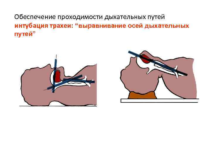 Обеспечение проходимости дыхательных путей интубация трахеи: “выравнивание осей дыхательных путей” 