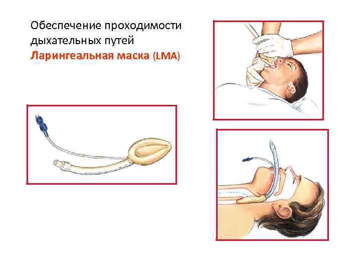 Обеспечение проходимости дыхательных путей Ларингеальная маска (LMA) 