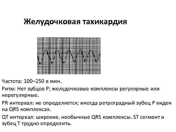 Желудочковая тахикардия Частота: 100– 250 в мин. Ритм: Нет зубцов Р; желудочковые комплексы регулярные