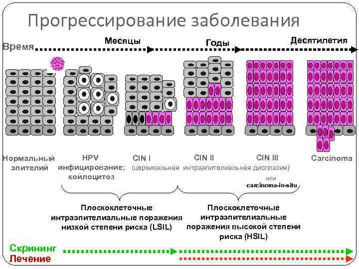 Прогрессирование заболевания Месяцы Время Десятилетия Годы HPV CIN III Нормальный CIN I эпителий инфицирование;