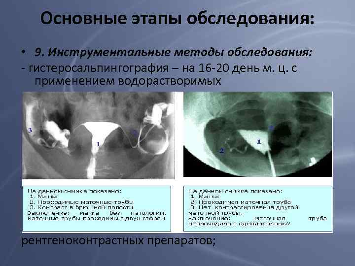 Основные этапы обследования: • 9. Инструментальные методы обследования: - гистеросальпингография – на 16 -20