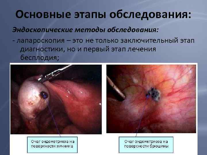 Основные этапы обследования: Эндоскопические методы обследования: - лапароскопия – это не только заключительный этап