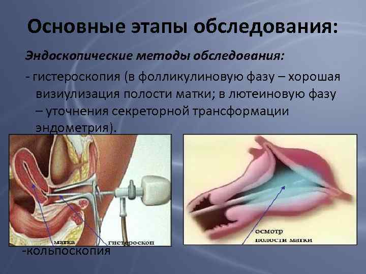 Основные этапы обследования: Эндоскопические методы обследования: - гистероскопия (в фолликулиновую фазу – хорошая визиулизация