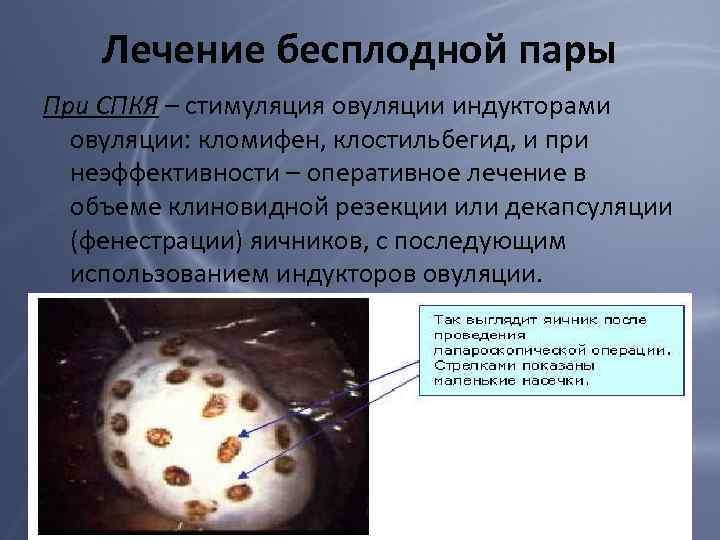 Лечение бесплодной пары При СПКЯ – стимуляция овуляции индукторами овуляции: кломифен, клостильбегид, и при