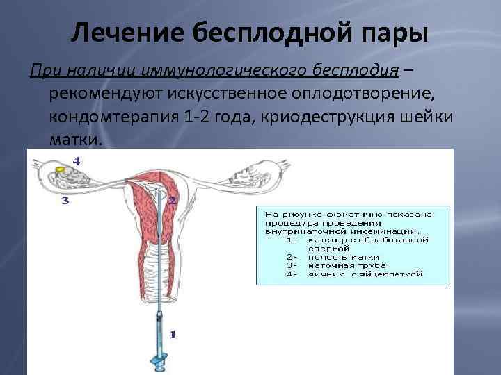 Лечение бесплодной пары При наличии иммунологического бесплодия – рекомендуют искусственное оплодотворение, кондомтерапия 1 -2