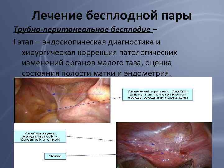 Лечение бесплодной пары Трубно-перитонеальное бесплодие – I этап – эндоскопическая диагностика и хирургическая коррекция