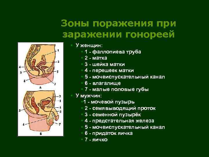 Зоны поражения при заражении гонореей § У женщин: § 1 - фаллопиева труба §