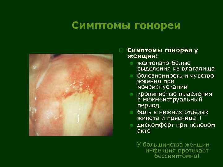 Симптомы гонореи o Симптомы гонореи у женщин: n желтовато-белые выделения из влагалища n болезненность