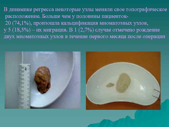 В динамике регресса некоторые узлы меняли свое топографическое расположение. Больше чем у половины пациенток