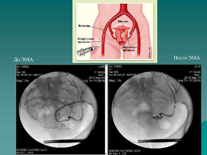 До ЭМА После ЭМА 