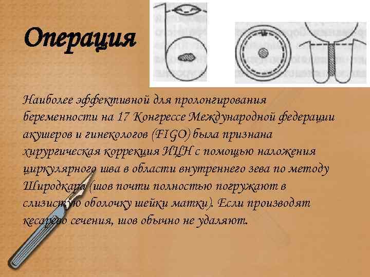 Операция Наиболее эффективной для пролонгирования беременности на 17 Конгрессе Международной федерации акушеров и гинекологов