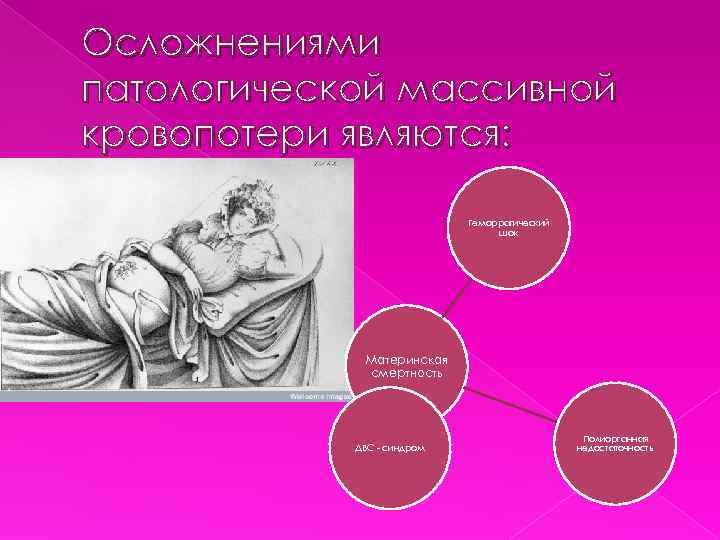 Осложнениями патологической массивной кровопотери являются: Геморрагический шок Материнская смертность ДВС - синдром Полиорганная недостаточность