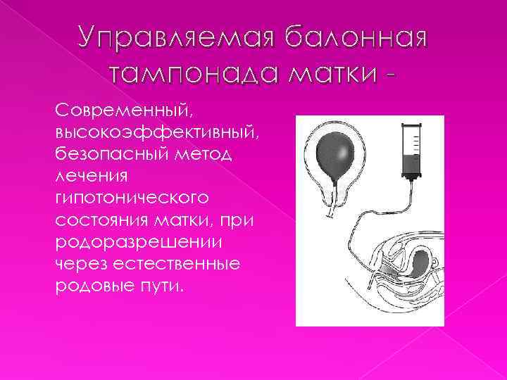 Управляемая балонная тампонада матки Современный, высокоэффективный, безопасный метод лечения гипотонического состояния матки, при родоразрешении