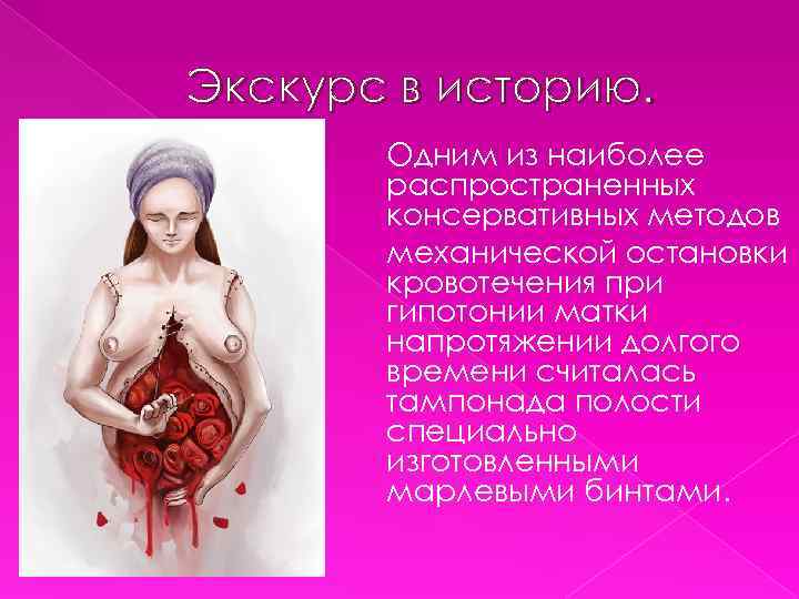 Экскурс в историю. Одним из наиболее распространенных консервативных методов механической остановки кровотечения при гипотонии
