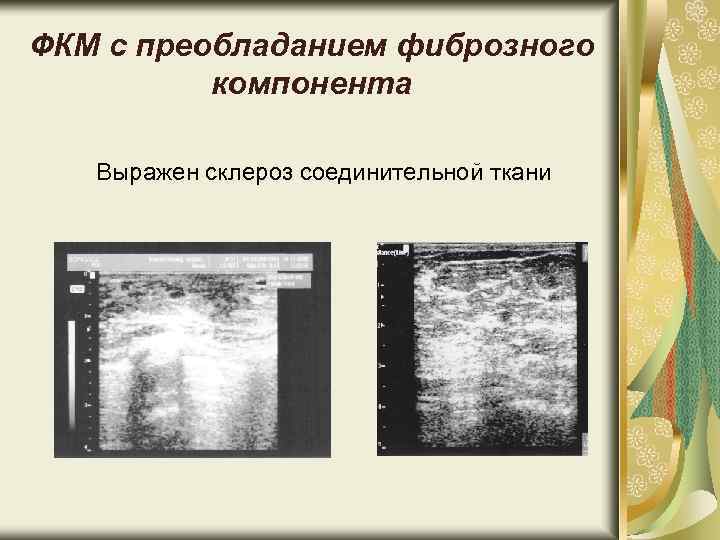ФКМ с преобладанием фиброзного компонента Выражен склероз соединительной ткани 