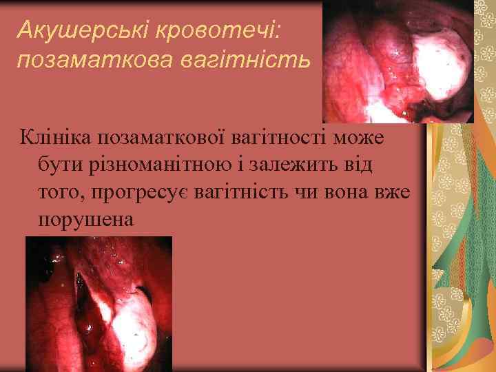 Акушерські кровотечі: позаматкова вагітність Клініка позаматкової вагітності може бути різноманітною і залежить від того,