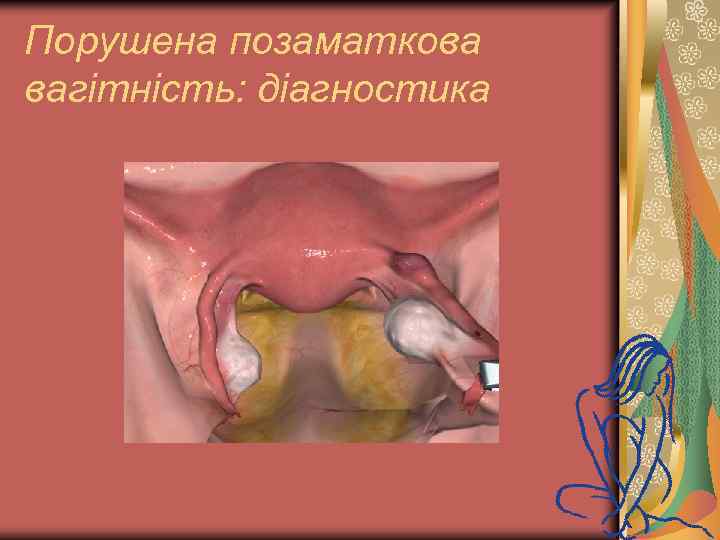 Порушена позаматкова вагітність: діагностика 