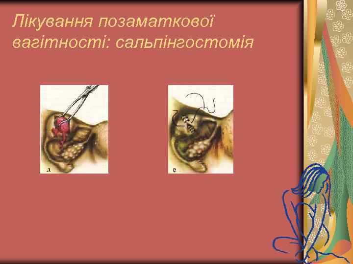 Лікування позаматкової вагітності: сальпінгостомія 