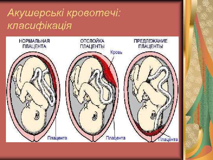 Акушерські кровотечі: класифікація 