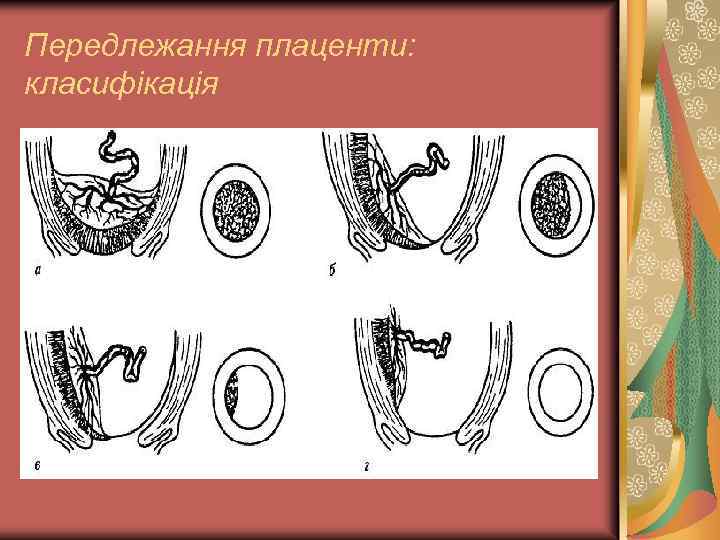 Передлежання плаценти: класифікація 