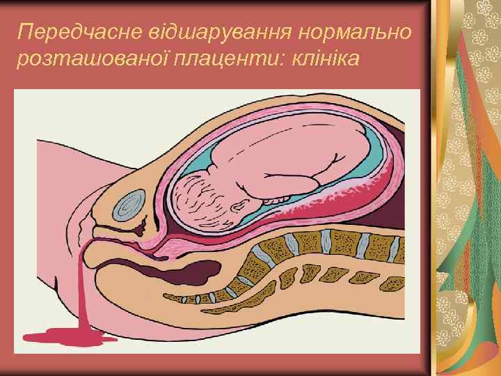 Передчасне відшарування нормально розташованої плаценти: клініка 