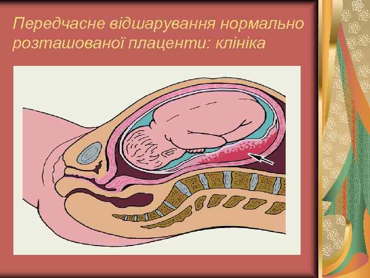 Передчасне відшарування нормально розташованої плаценти: клініка 