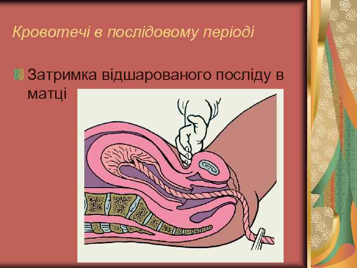 Кровотечі в послідовому періоді Затримка відшарованого посліду в матці 