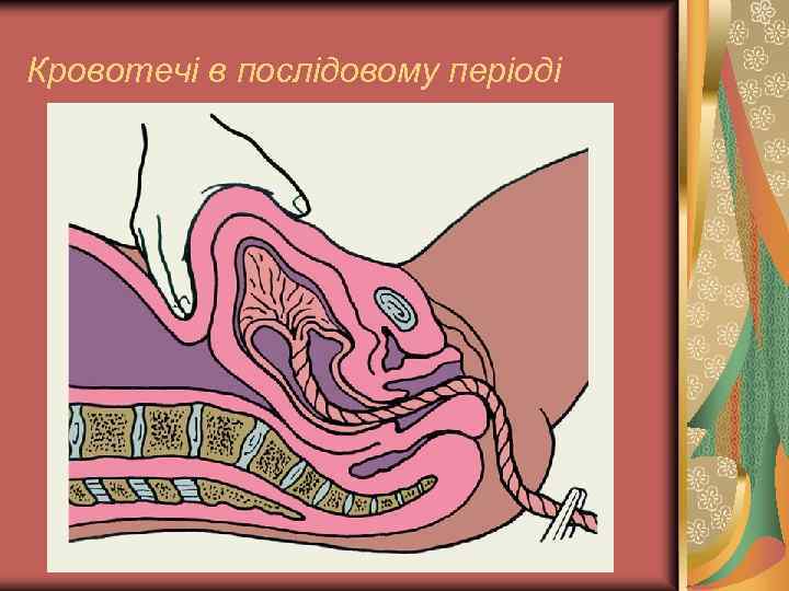 Кровотечі в послідовому періоді 