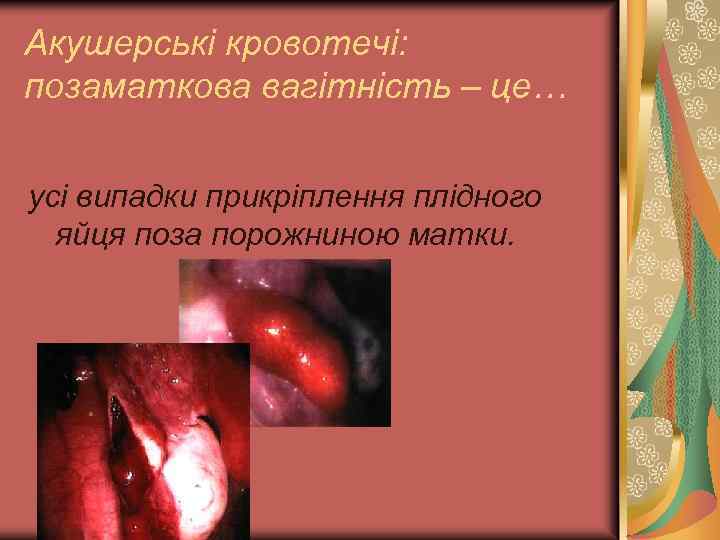 Акушерські кровотечі: позаматкова вагітність – це… усі випадки прикріплення плідного яйця поза порожниною матки.