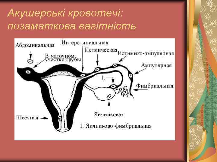 Акушерські кровотечі: позаматкова вагітність 