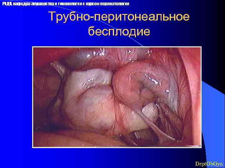 РУДН, кафедра акушерства и гинекологии с курсом перинатологии Трубно-перитонеальное бесплодие Dept. Ob. Gyn 