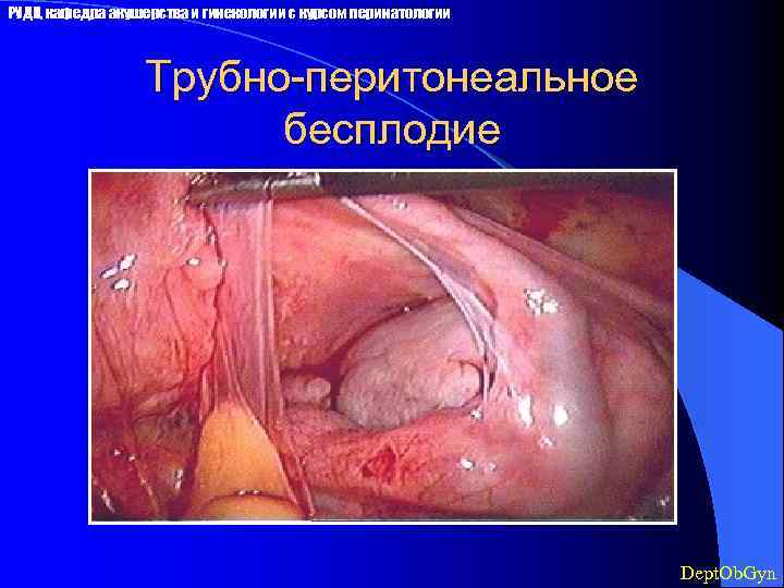 РУДН, кафедра акушерства и гинекологии с курсом перинатологии Трубно-перитонеальное бесплодие Dept. Ob. Gyn 