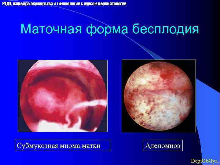 РУДН, кафедра акушерства и гинекологии с курсом перинатологии Маточная форма бесплодия Субмукозная миома матки