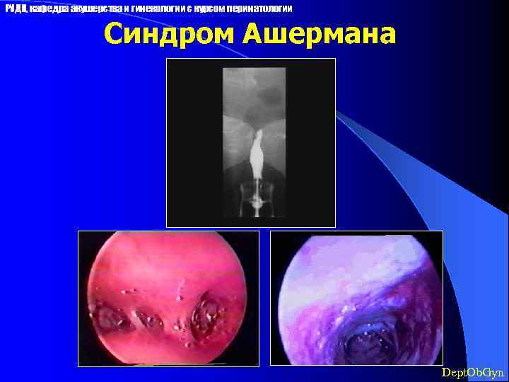 РУДН, кафедра акушерства и гинекологии с курсом перинатологии Синдром Ашермана Dept. Ob. Gyn 