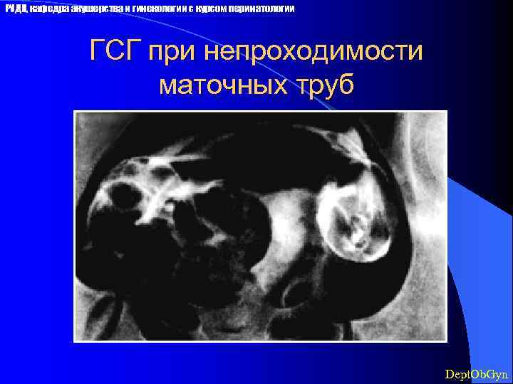 РУДН, кафедра акушерства и гинекологии с курсом перинатологии ГСГ при непроходимости маточных труб Dept.